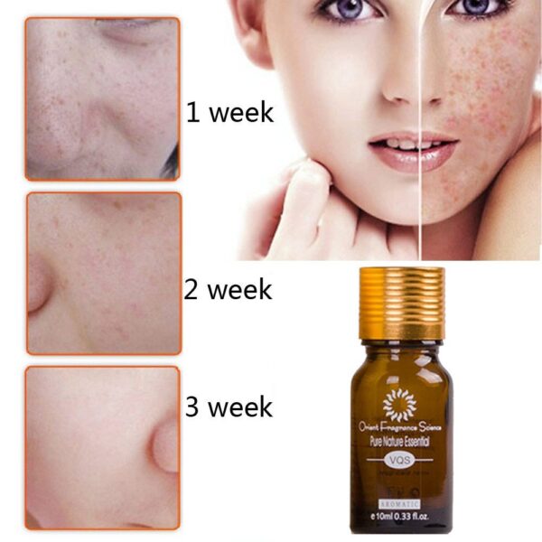 Dredge Meridian Skin Care Natural Pure Removal Acne Stretch Marks Scar Removal Essence oil - Image 3